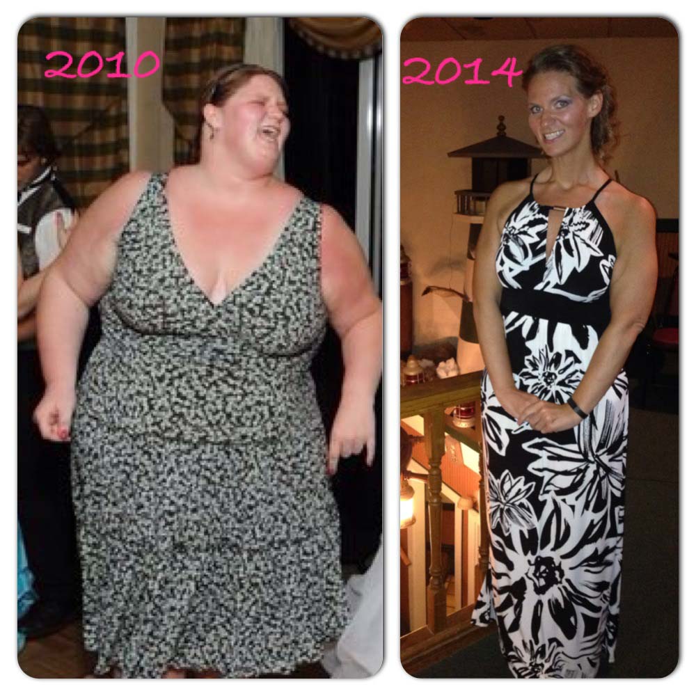 Michelle Before And After Lap Band Surgery | Obesity Coverage