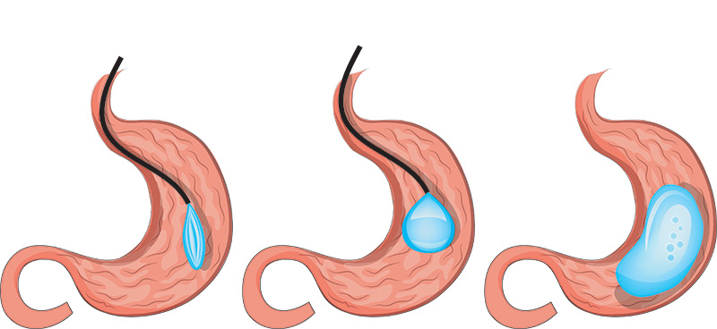 Before And After Your Gastric Balloon [Complete Guide]